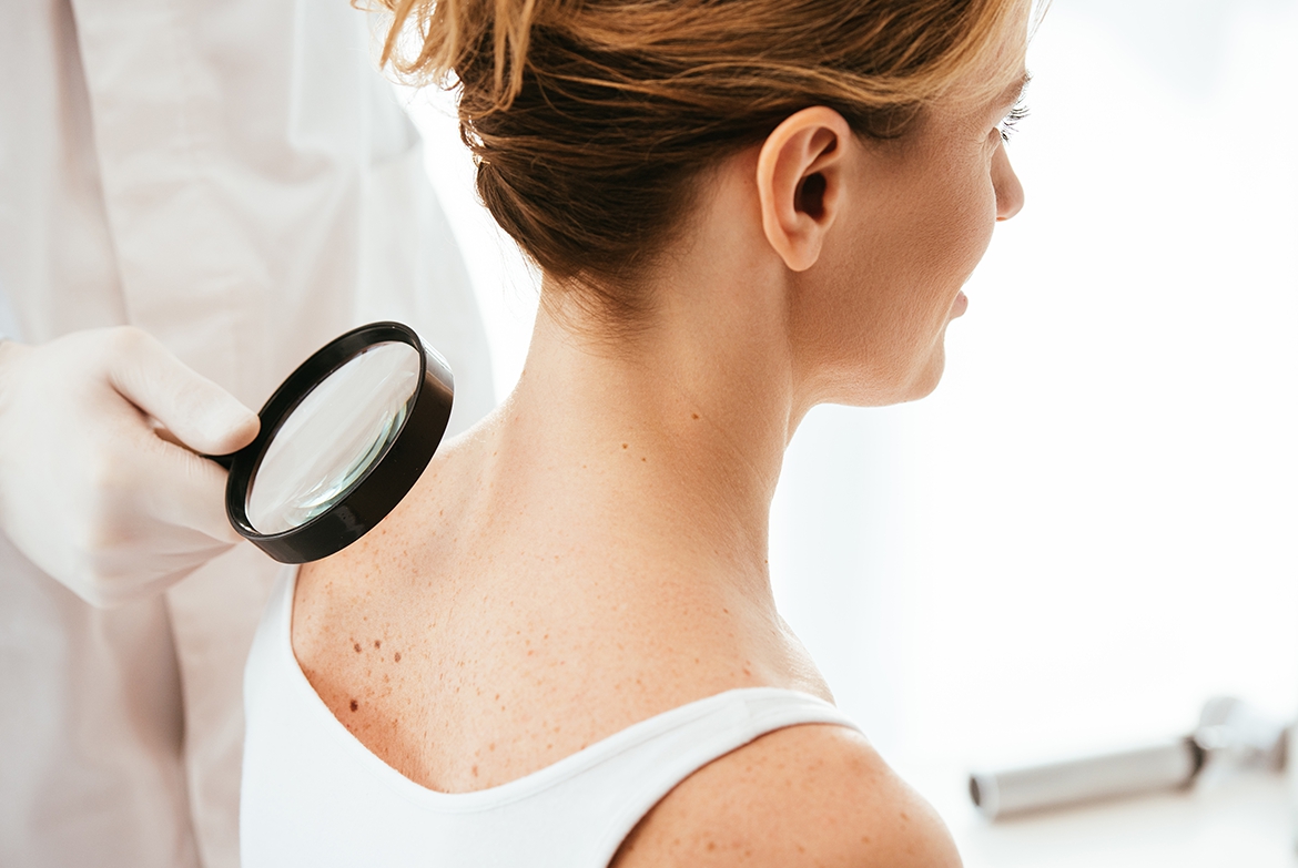 Früherkennung von Melanomen